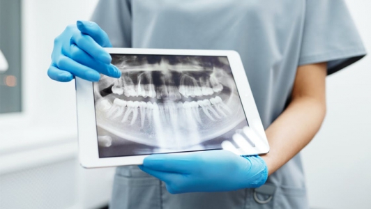 Gömülü Diş Nedir? Gömülü Diş Nasıl Tedavi Edilir?